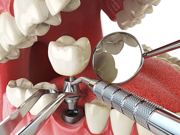 Best Lost Filling or Crown Replacement in Dermott, AR